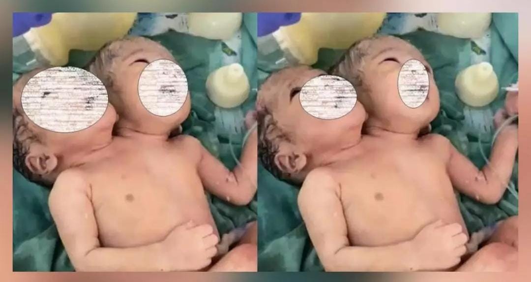 📰 इंदौर में चमत्कार: दो सिर वाले नवजात का जन्म, मेडिकल साइंस के लिए बड़ी चुनौती